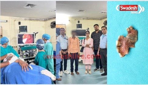 The teeth were stuck in the food pipe, the doctor at BMHRC removed them without surgery