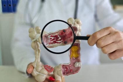 कोलन कैंसर