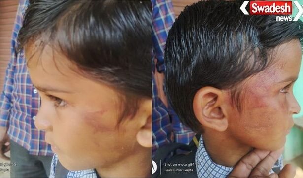 बलरामपुर: शराब के नशे में शिक्षक ने बच्चों को थप्पड़ मारे, बच्चा गंभीर रूप से घायल