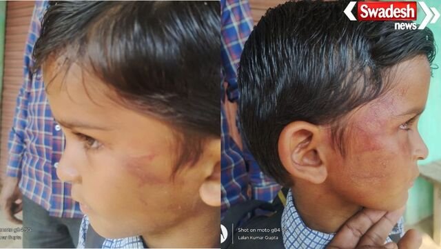 बलरामपुर: शराब के नशे में शिक्षक ने बच्चों को थप्पड़ मारे, बच्चा गंभीर रूप से घायल