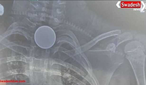 कोरबा में दर्दनाक हादसा: खेलते समय 8 साल के बच्चे ने निगल लिया सिक्का, सीने में फंसने से मौत