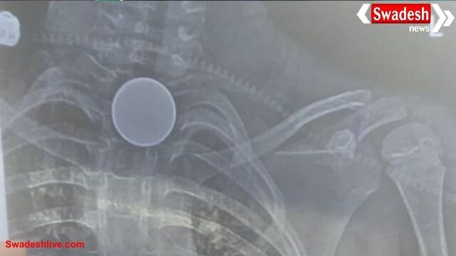 कोरबा में दर्दनाक हादसा: खेलते समय 8 साल के बच्चे ने निगल लिया सिक्का, सीने में फंसने से मौत