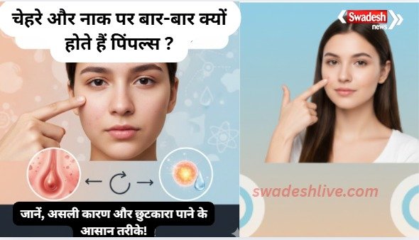 Ayurvedic Medicine for Pimples