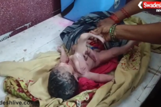 Rare Four-Limbed Baby Born in Chhatarpur