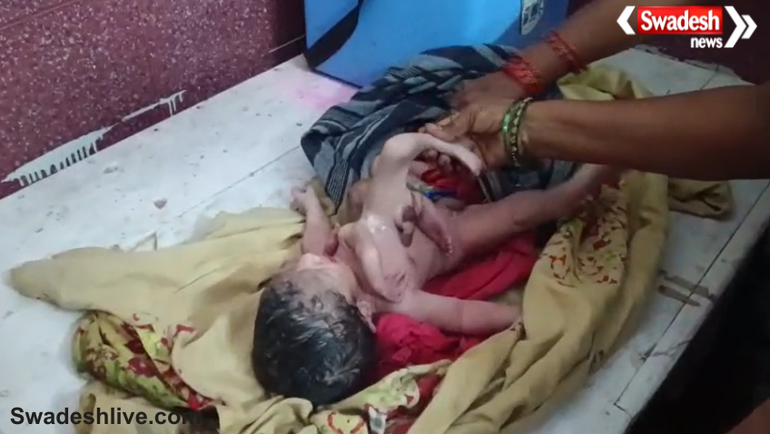 Rare Four-Limbed Baby Born in Chhatarpur