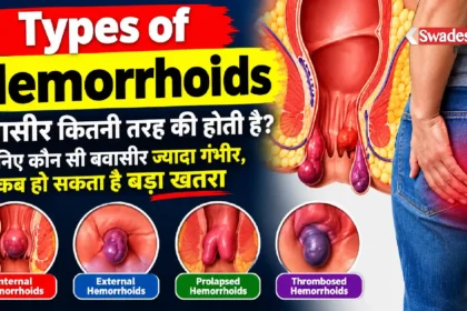 Types of Hemorrhoids