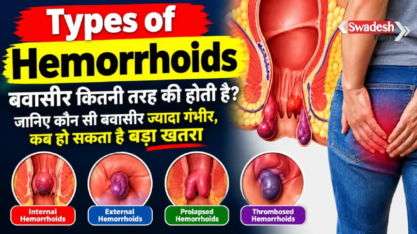Types of Hemorrhoids